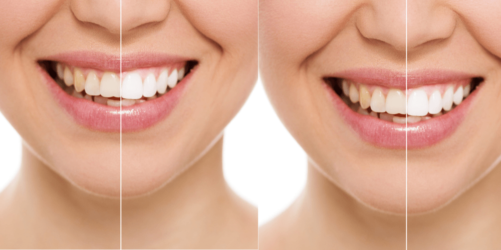 Why do consumers prefer whitening strips over teeth whitening treatment